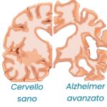 Mese mondiale dell’Alzheimer: la diagnosi precoce può fare la differenza Mese mondiale dell’Alzheimer: la diagnosi precoce può fare la differenza