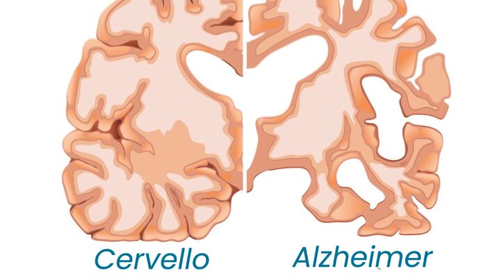 Mese mondiale dell’Alzheimer: la diagnosi precoce può fare la differenza